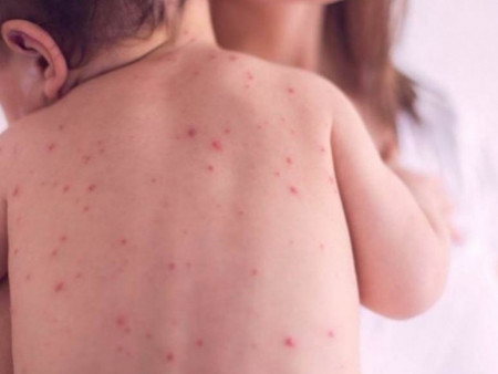 ХӨСҮТ: Улаанбурхан өвчний батлагдсан тохиолдол 8 нэмэгджээ
