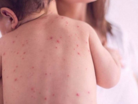 ХӨСҮТ: Улаанбурхан өвчний халдвар буурчээ