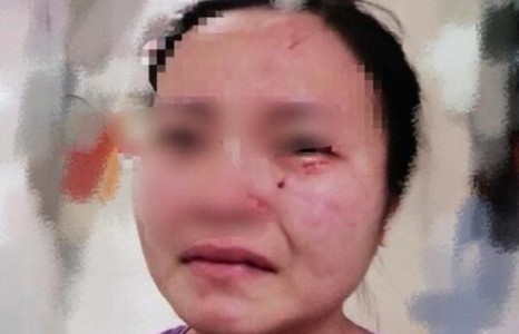 News paparazzi : Гуанжоу хотод тусгаарлалтад байсан гадаадын иргэн сувилагчийн нүүрийг хазсан хэрэг гарчээ